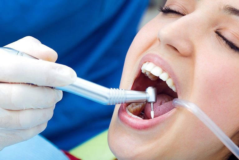 Root-Canal-Treatment-2x-1