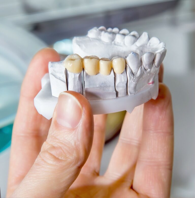 Hand-holding-tooth-model-with-porcelain-dental-bridge-in-Branford